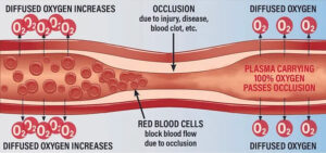 Hyperbaric Oxygen Therapy - Us Wound Care